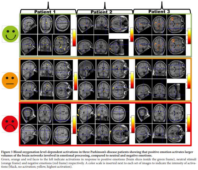 three parkinson's disease patients showing that positive emotion